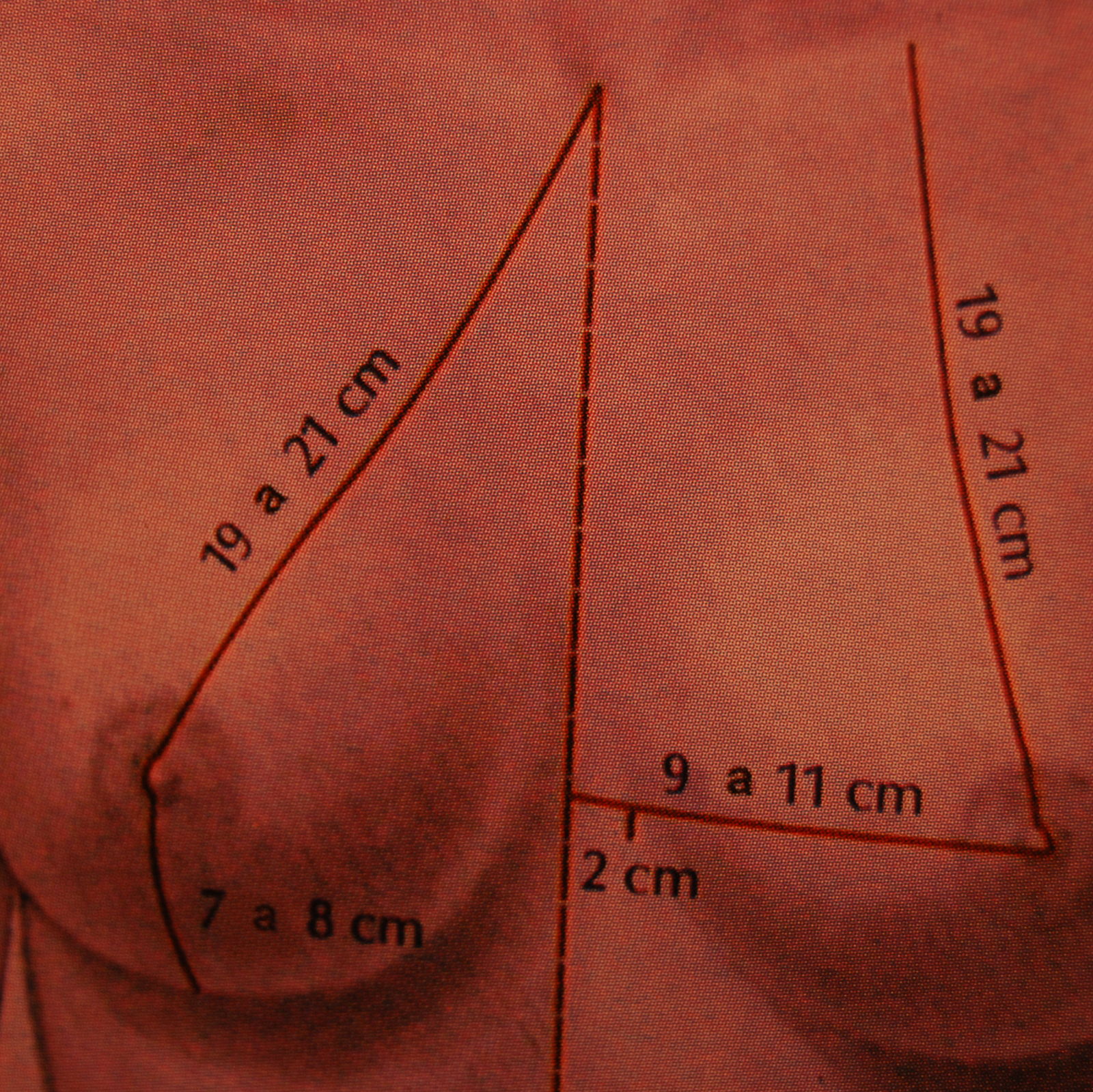Dorzalnaya de la parte izquierda paramediannaya la hernia del disco intervertebral