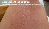 Que es foliculitis vulvar