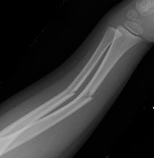 FRACTURA RADIO fractura radio: