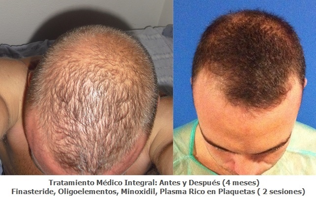 Los champúes medicinales de la caída de los cabello