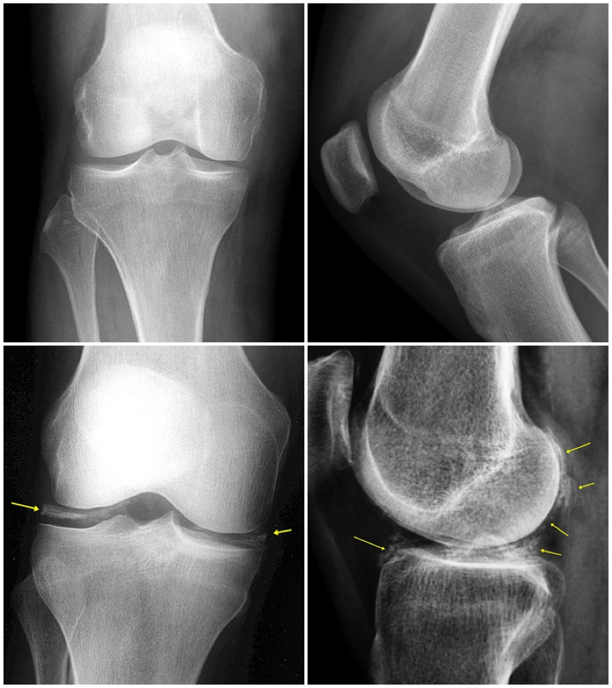 condrocalcinosis